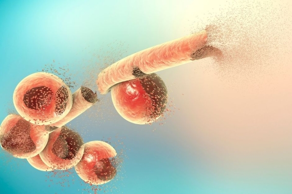 Infections