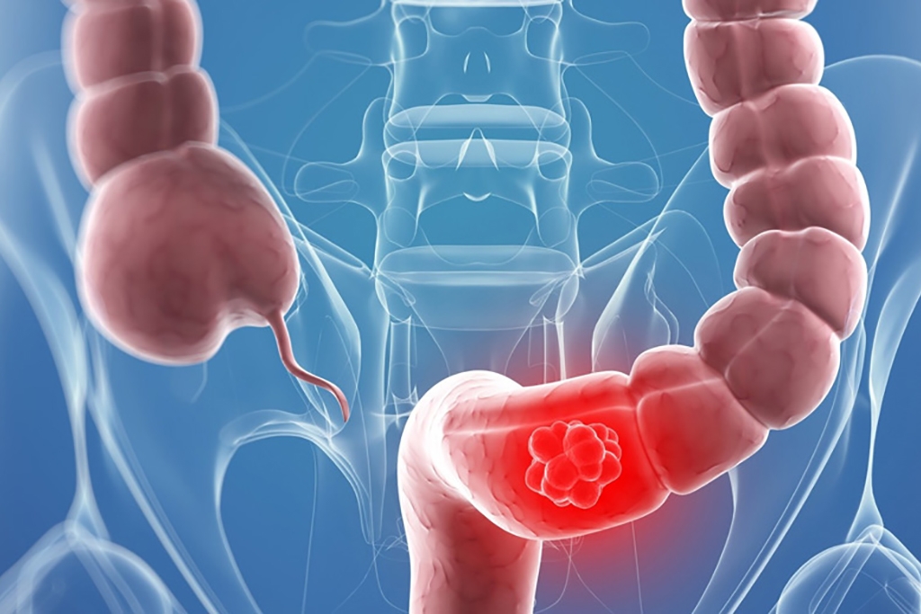Intestinal Microbiome - EnteroScan®
